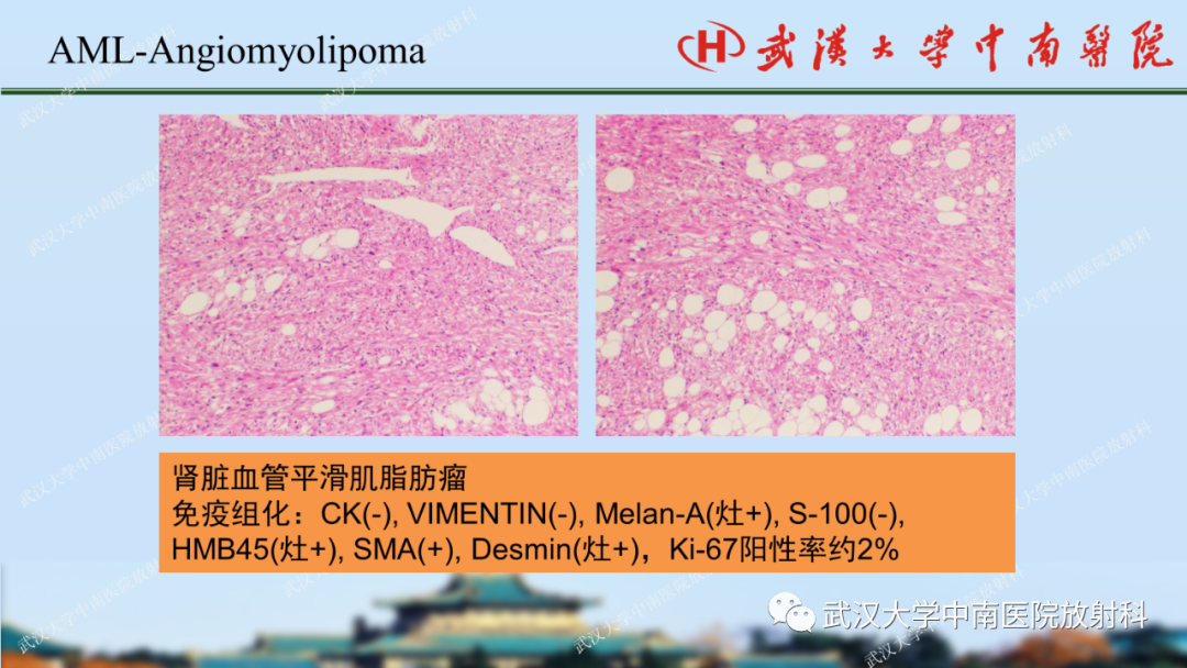影像PPT - 【PPT】肾脏解剖、实性肾肿瘤-28