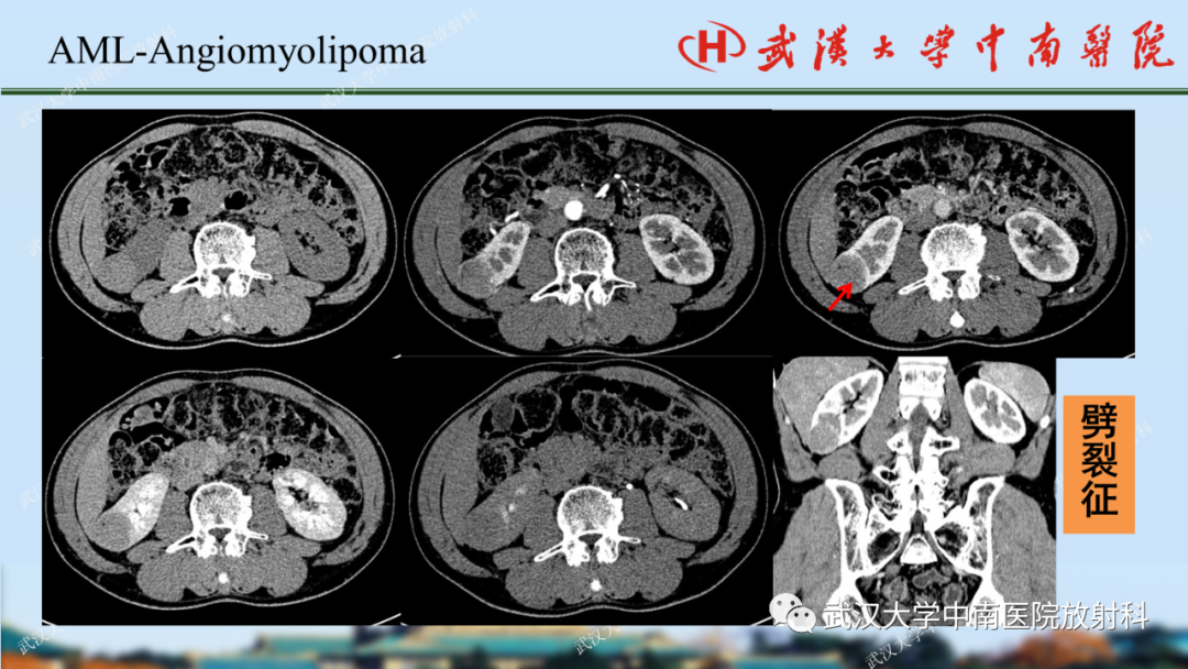 影像PPT - 【PPT】肾脏解剖、实性肾肿瘤-27