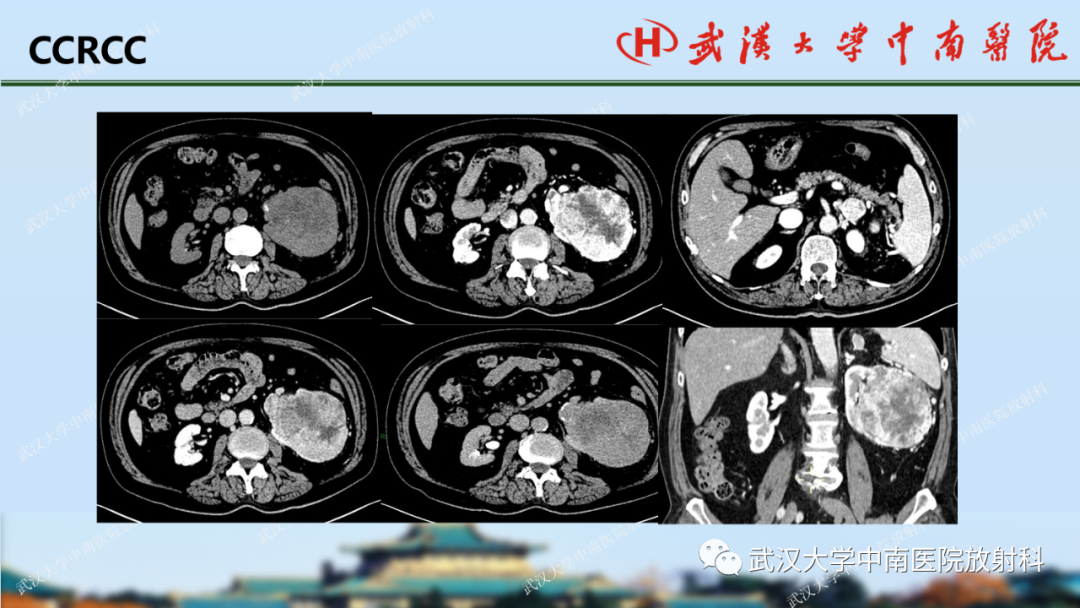 影像PPT - 【PPT】肾脏解剖、实性肾肿瘤-33