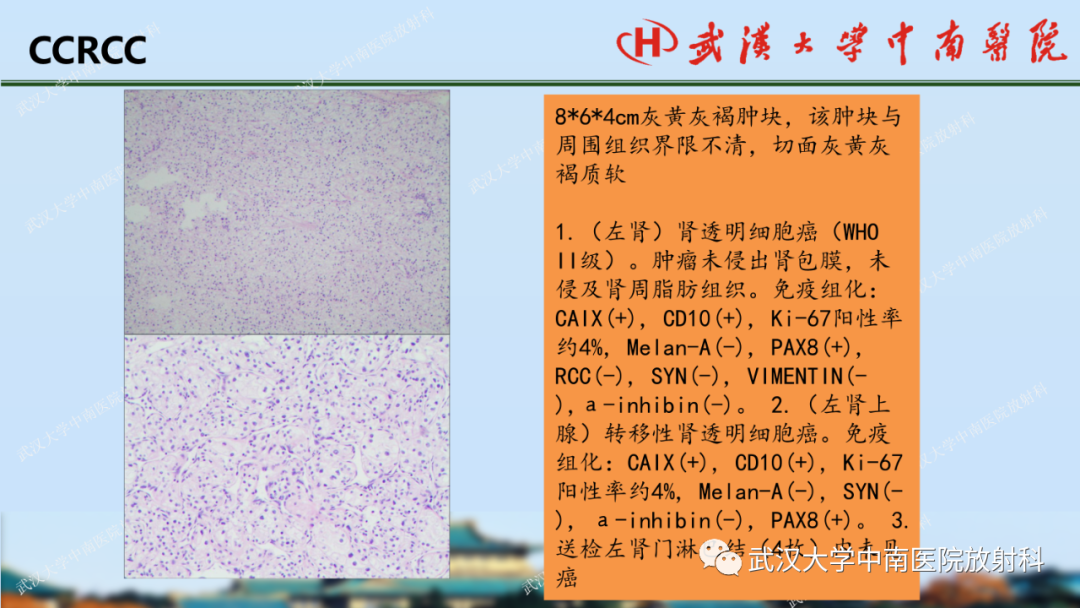 影像PPT - 【PPT】肾脏解剖、实性肾肿瘤-34