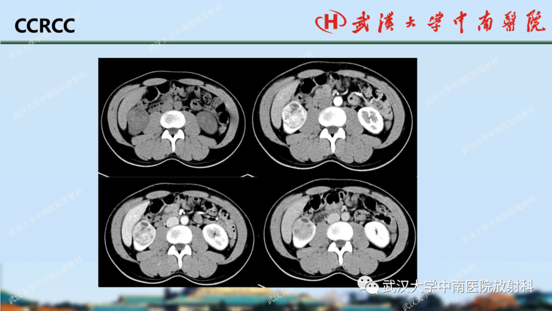 影像PPT - 【PPT】肾脏解剖、实性肾肿瘤-35