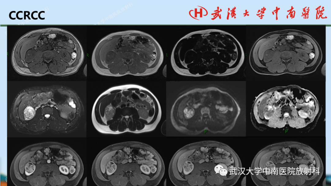 影像PPT - 【PPT】肾脏解剖、实性肾肿瘤-37