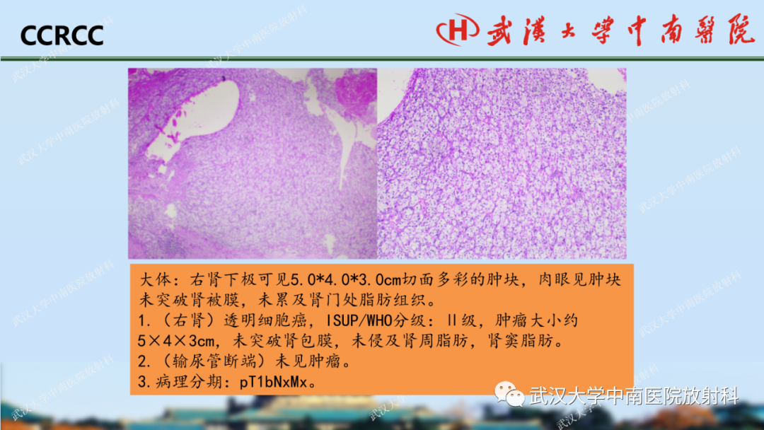 影像PPT - 【PPT】肾脏解剖、实性肾肿瘤-36