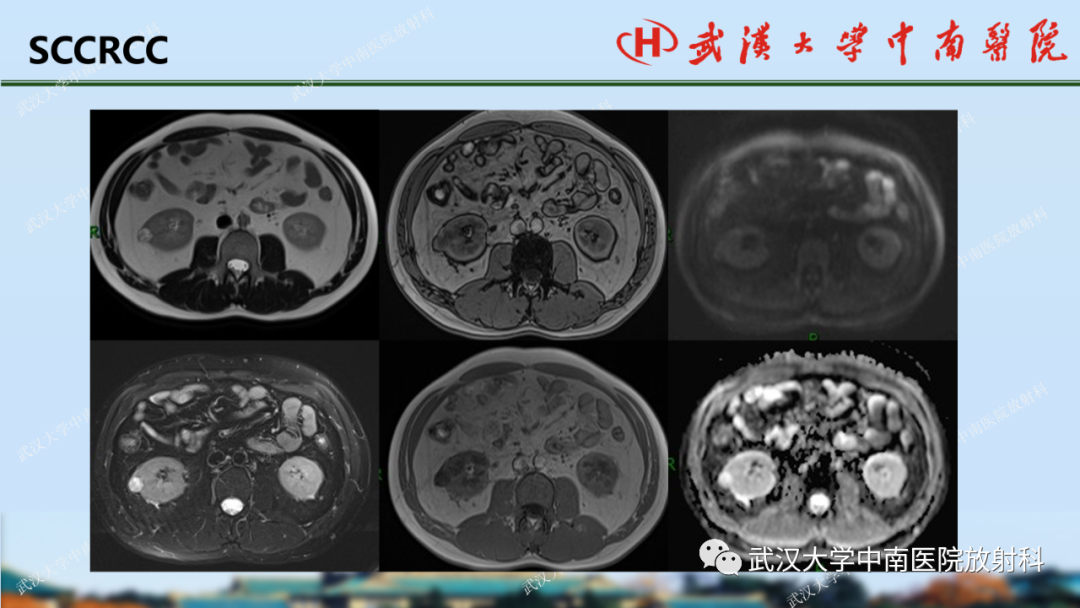 影像PPT - 【PPT】肾脏解剖、实性肾肿瘤-40