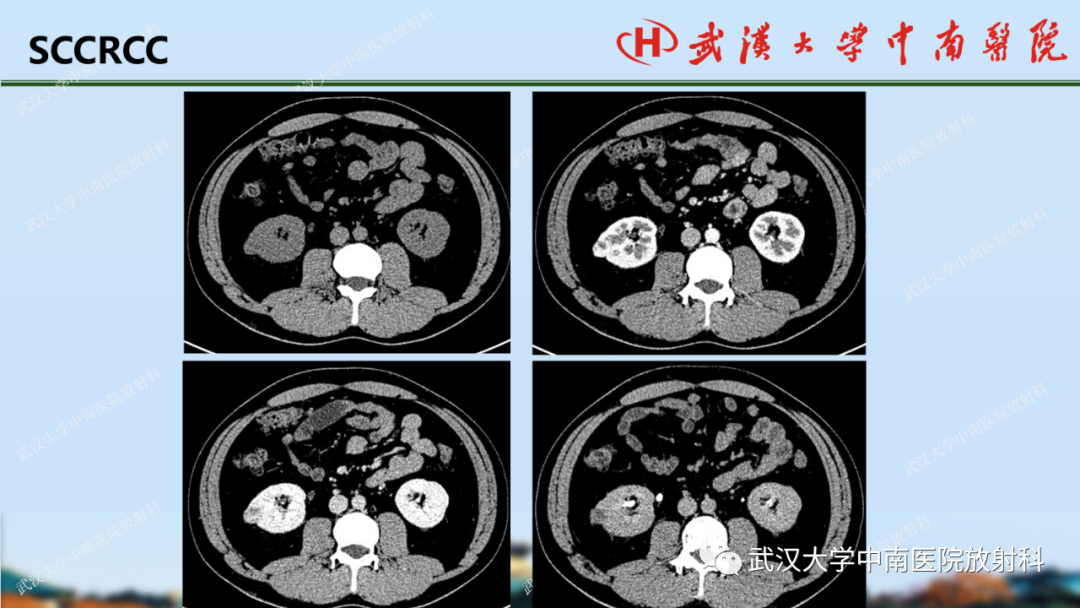 影像PPT - 【PPT】肾脏解剖、实性肾肿瘤-39
