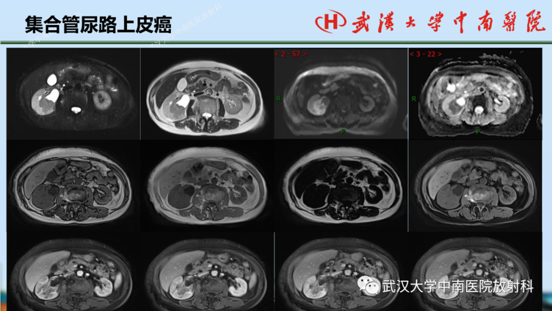 影像PPT - 【PPT】肾脏解剖、实性肾肿瘤-52