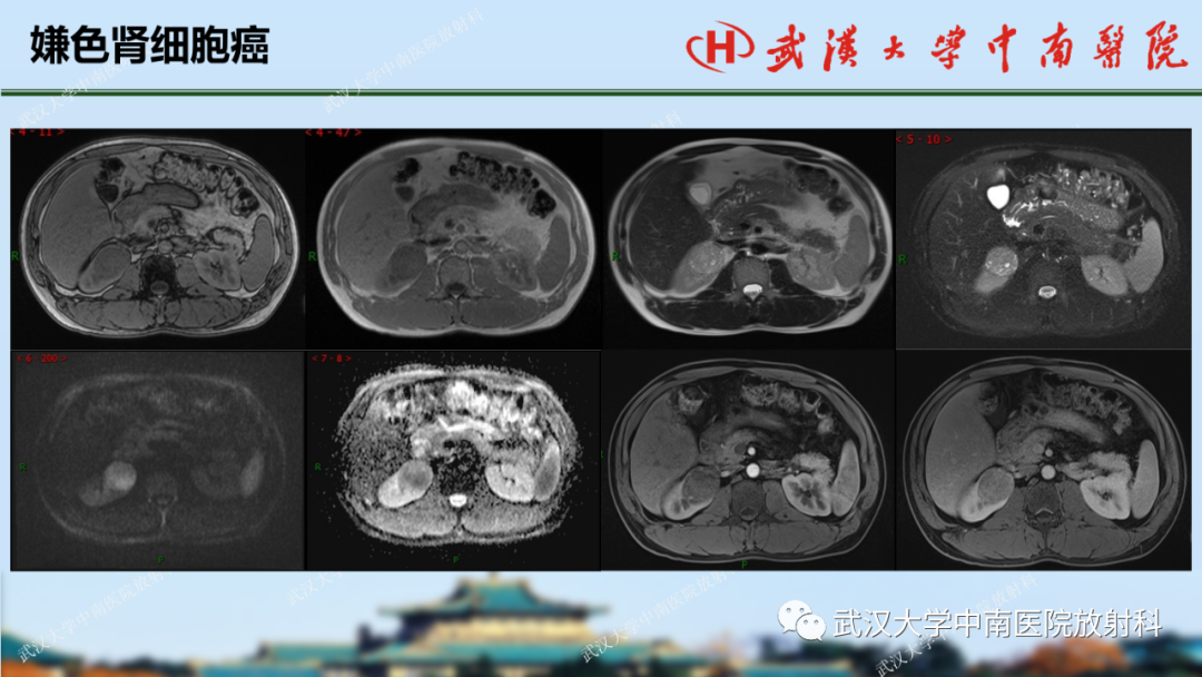 影像PPT - 【PPT】肾脏解剖、实性肾肿瘤-50