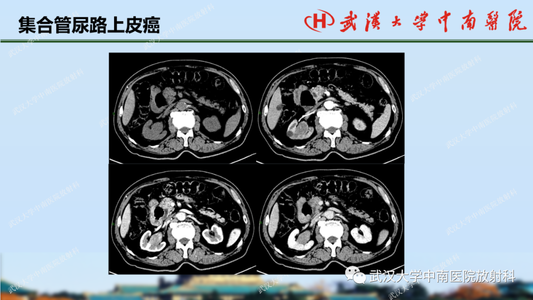 影像PPT - 【PPT】肾脏解剖、实性肾肿瘤-53