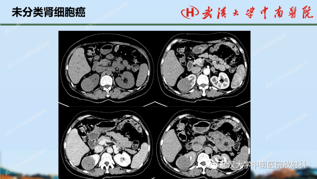 影像PPT - 【PPT】肾脏解剖、实性肾肿瘤-58