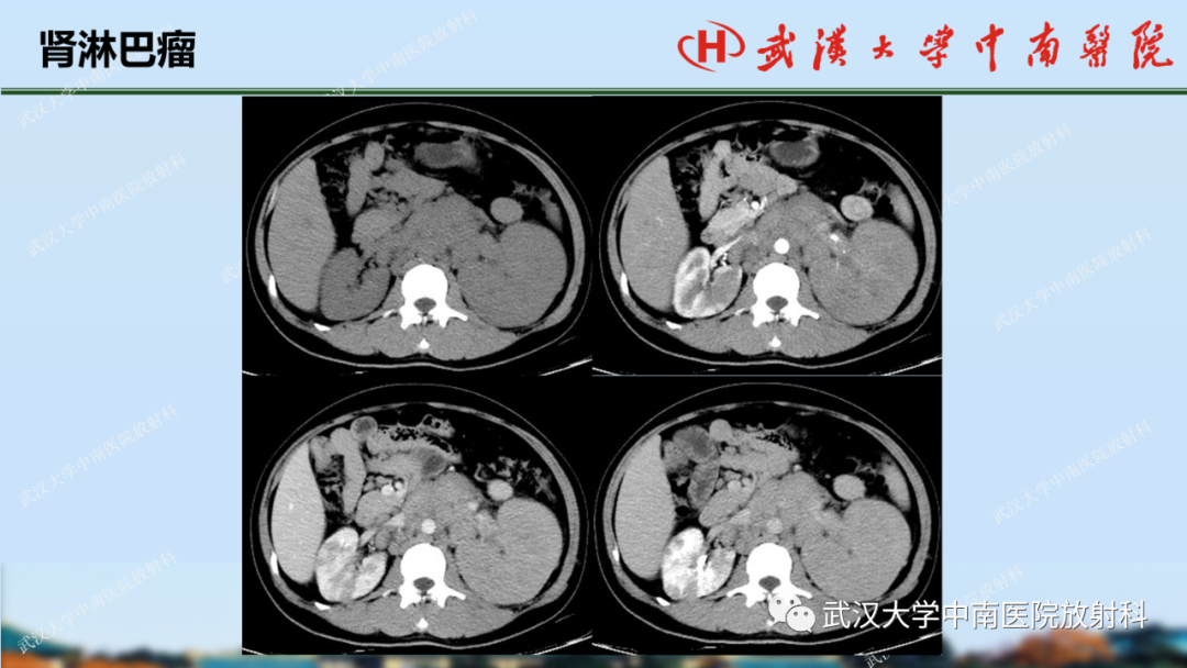 影像PPT - 【PPT】肾脏解剖、实性肾肿瘤-62
