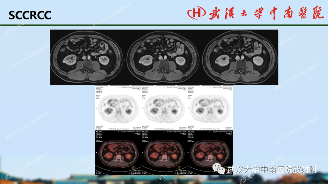 影像PPT - 【PPT】肾脏解剖、实性肾肿瘤-41