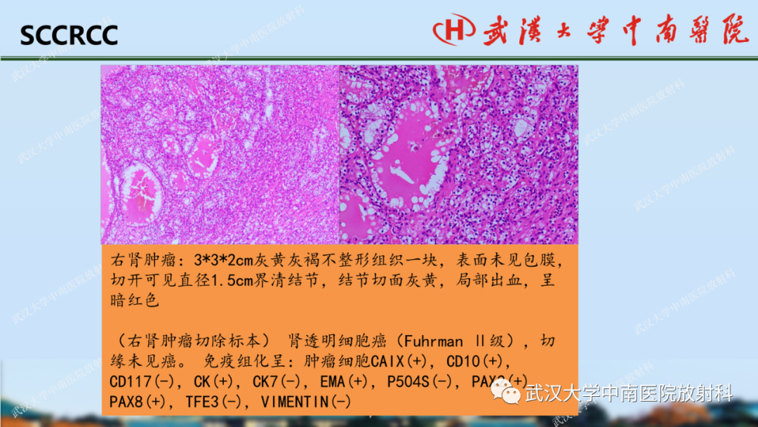 影像PPT - 【PPT】肾脏解剖、实性肾肿瘤-42