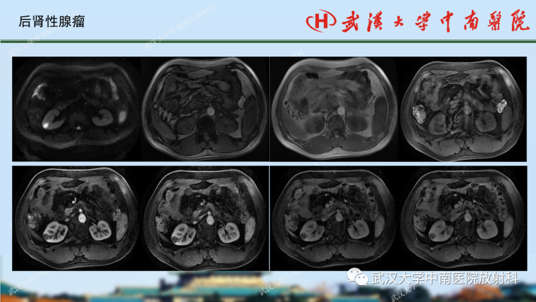影像PPT - 【PPT】肾脏解剖、实性肾肿瘤-68