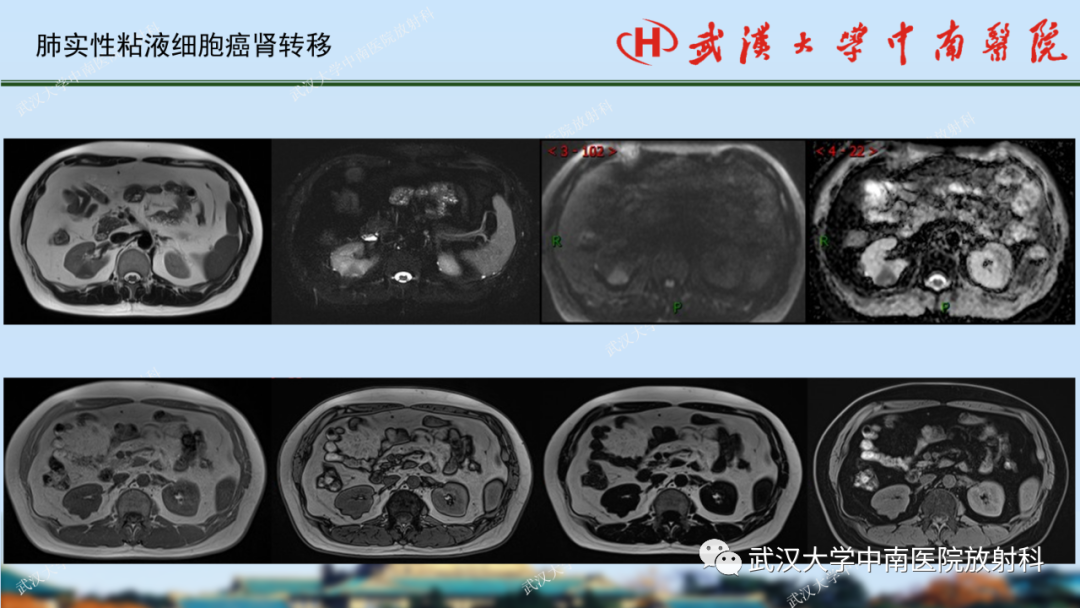 影像PPT - 【PPT】肾脏解剖、实性肾肿瘤-72