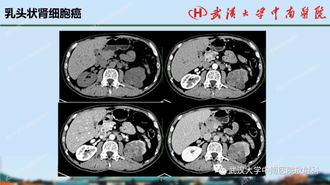 影像PPT - 【PPT】肾脏解剖、实性肾肿瘤-45