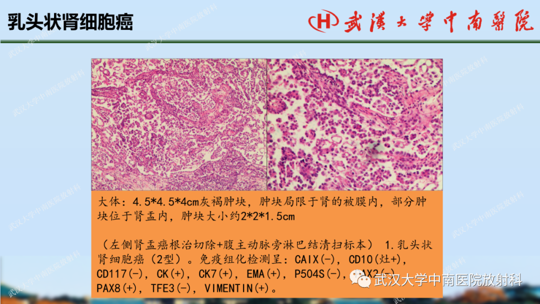 影像PPT - 【PPT】肾脏解剖、实性肾肿瘤-46
