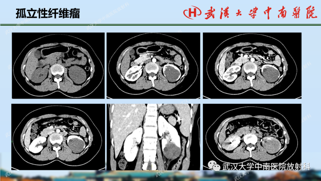 影像PPT - 【PPT】肾脏解剖、实性肾肿瘤-54