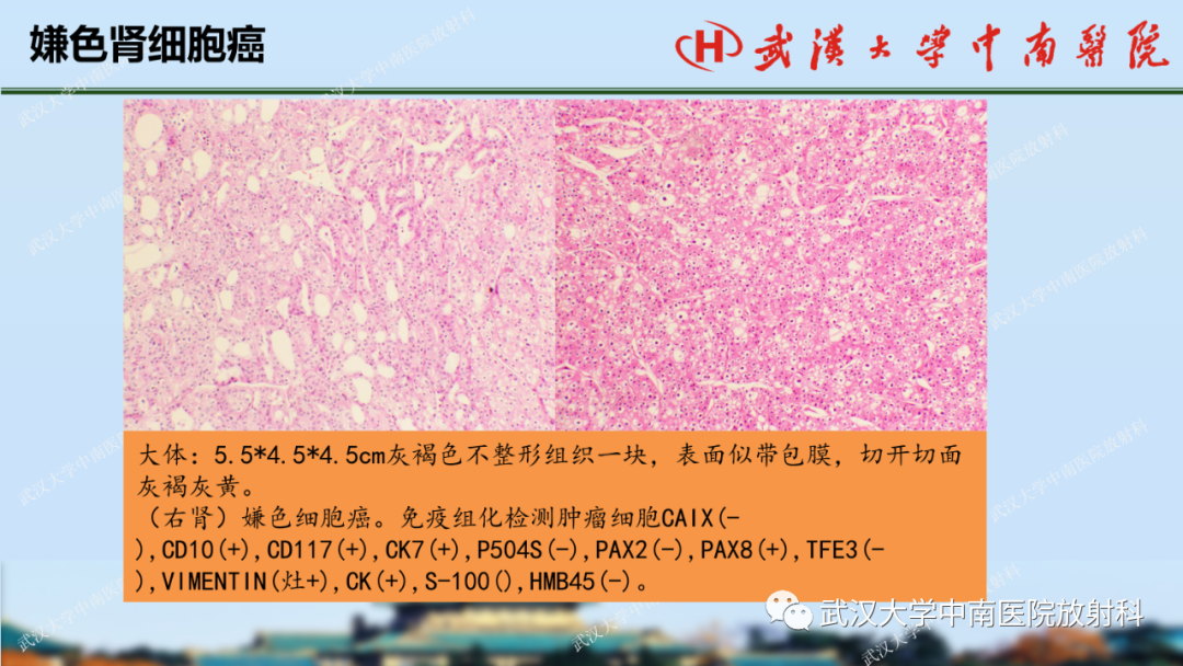 影像PPT - 【PPT】肾脏解剖、实性肾肿瘤-51