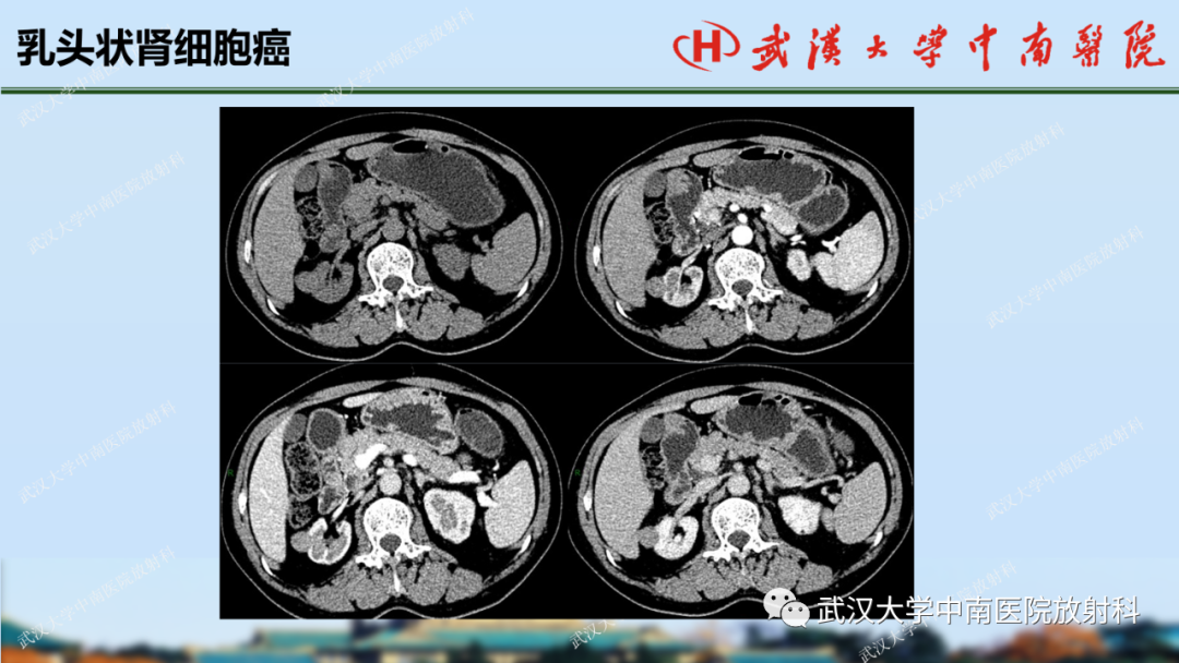 影像PPT - 【PPT】肾脏解剖、实性肾肿瘤-47