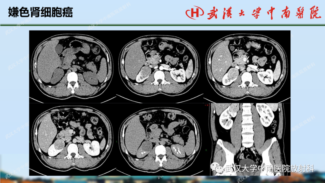 影像PPT - 【PPT】肾脏解剖、实性肾肿瘤-49