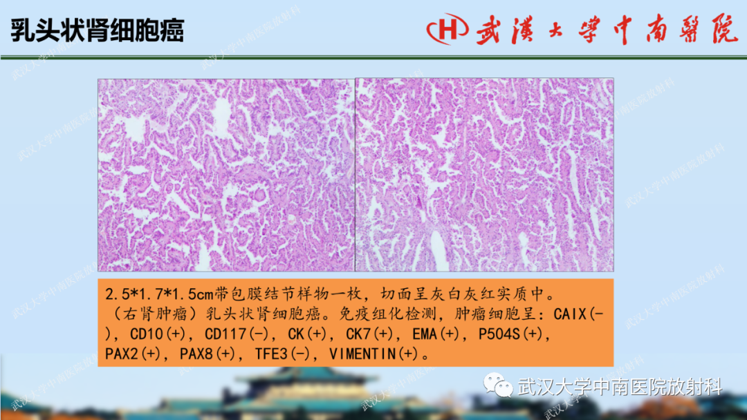 影像PPT - 【PPT】肾脏解剖、实性肾肿瘤-48