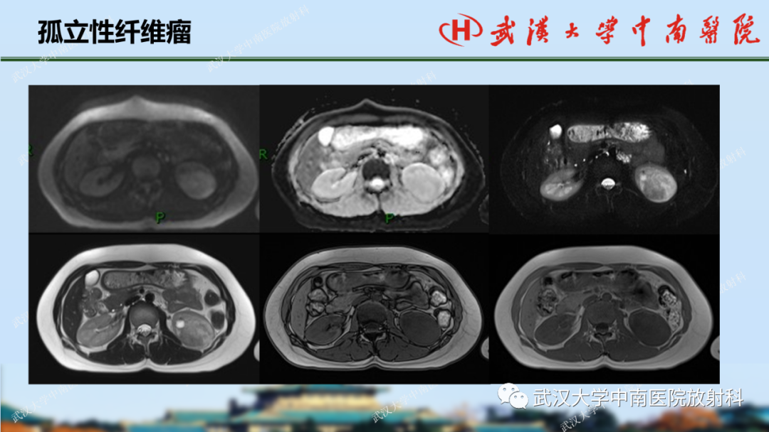 影像PPT - 【PPT】肾脏解剖、实性肾肿瘤-55