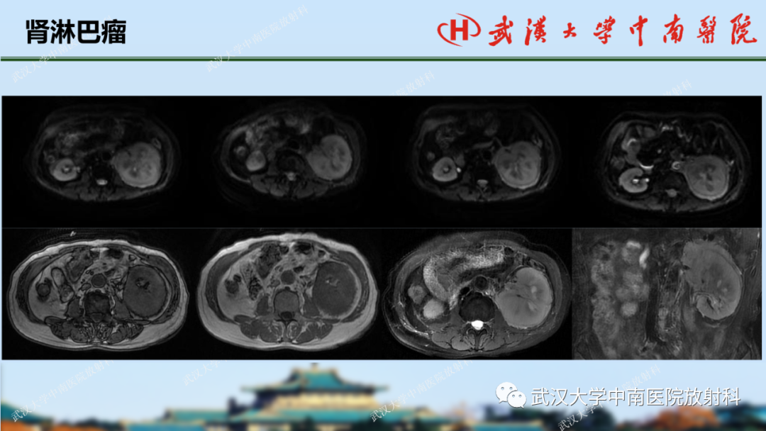 影像PPT - 【PPT】肾脏解剖、实性肾肿瘤-63