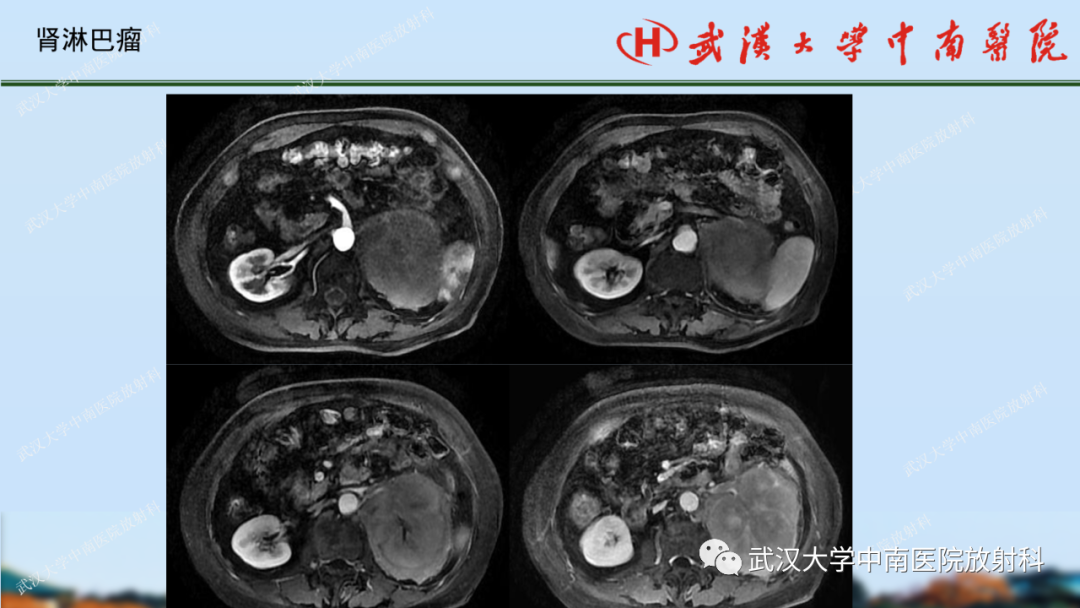影像PPT - 【PPT】肾脏解剖、实性肾肿瘤-64