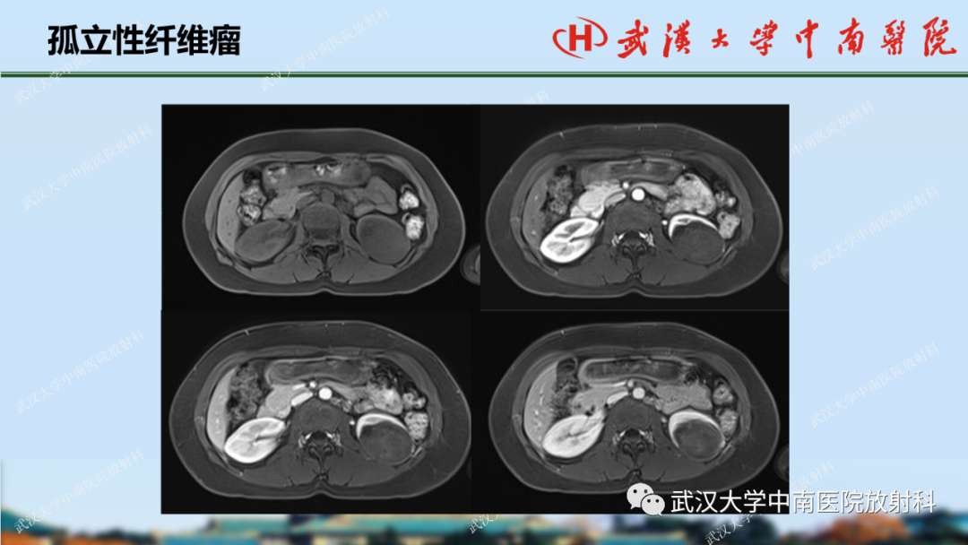 影像PPT - 【PPT】肾脏解剖、实性肾肿瘤-56