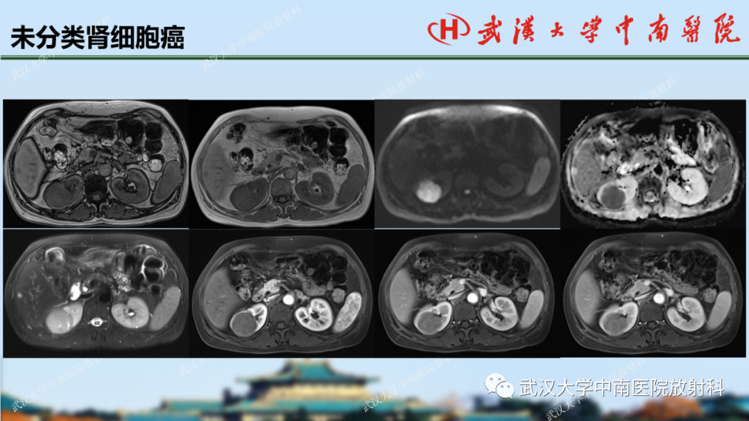 影像PPT - 【PPT】肾脏解剖、实性肾肿瘤-59