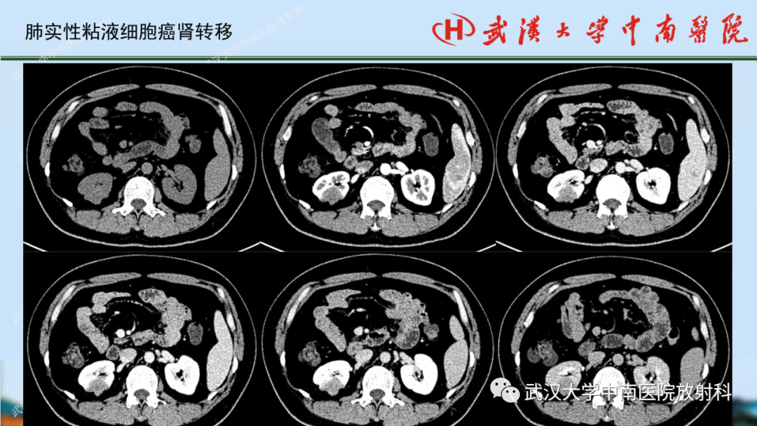 影像PPT - 【PPT】肾脏解剖、实性肾肿瘤-71