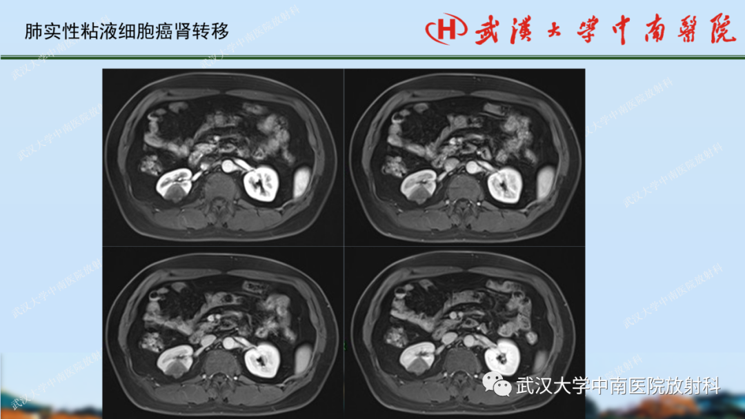 影像PPT - 【PPT】肾脏解剖、实性肾肿瘤-73