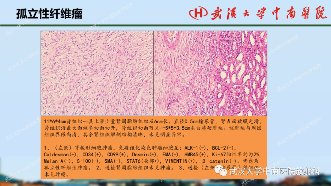 影像PPT - 【PPT】肾脏解剖、实性肾肿瘤-57