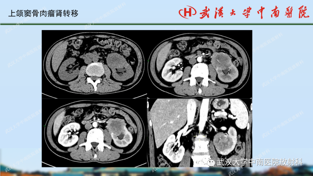 影像PPT - 【PPT】肾脏解剖、实性肾肿瘤-70