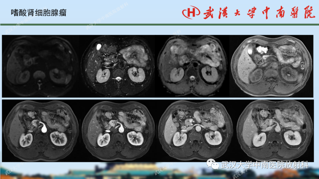 影像PPT - 【PPT】肾脏解剖、实性肾肿瘤-66