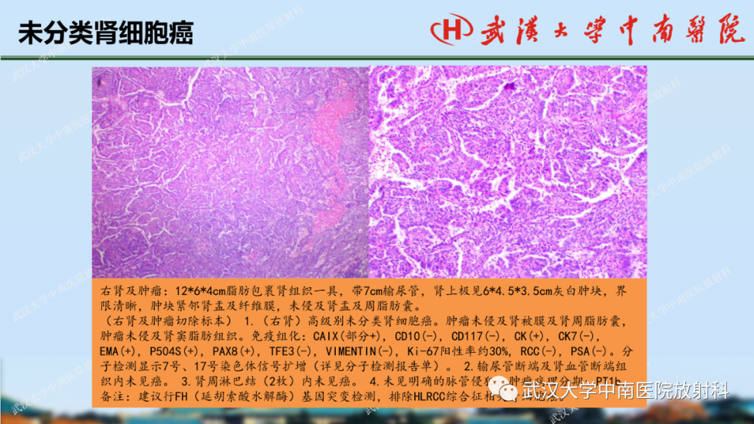 影像PPT - 【PPT】肾脏解剖、实性肾肿瘤-60