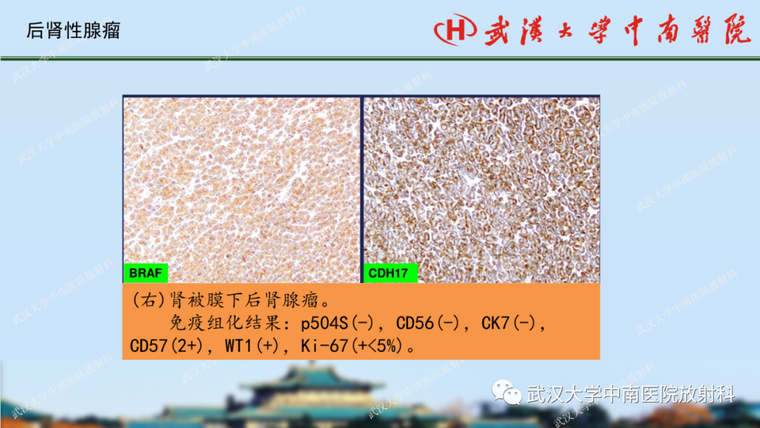 影像PPT - 【PPT】肾脏解剖、实性肾肿瘤-69