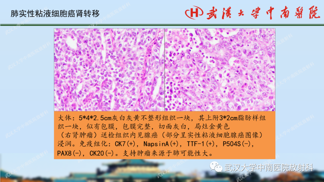 影像PPT - 【PPT】肾脏解剖、实性肾肿瘤-74