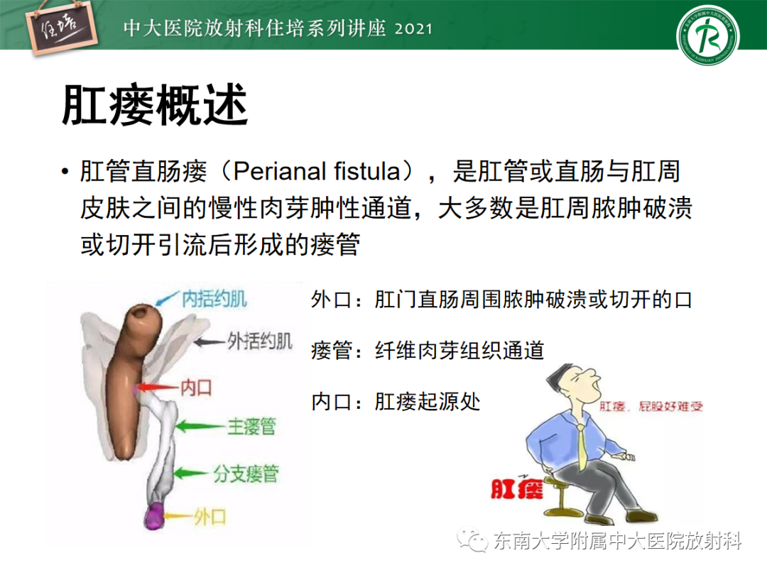 影像PPT - 【PPT】肛瘘的影像诊断及评估-2