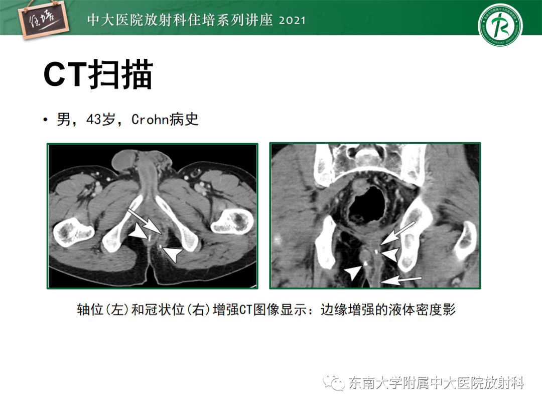 影像PPT - 【PPT】肛瘘的影像诊断及评估-12
