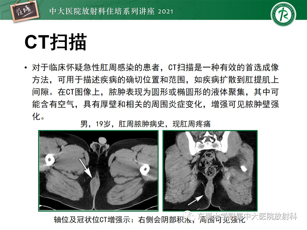 影像PPT - 【PPT】肛瘘的影像诊断及评估-11