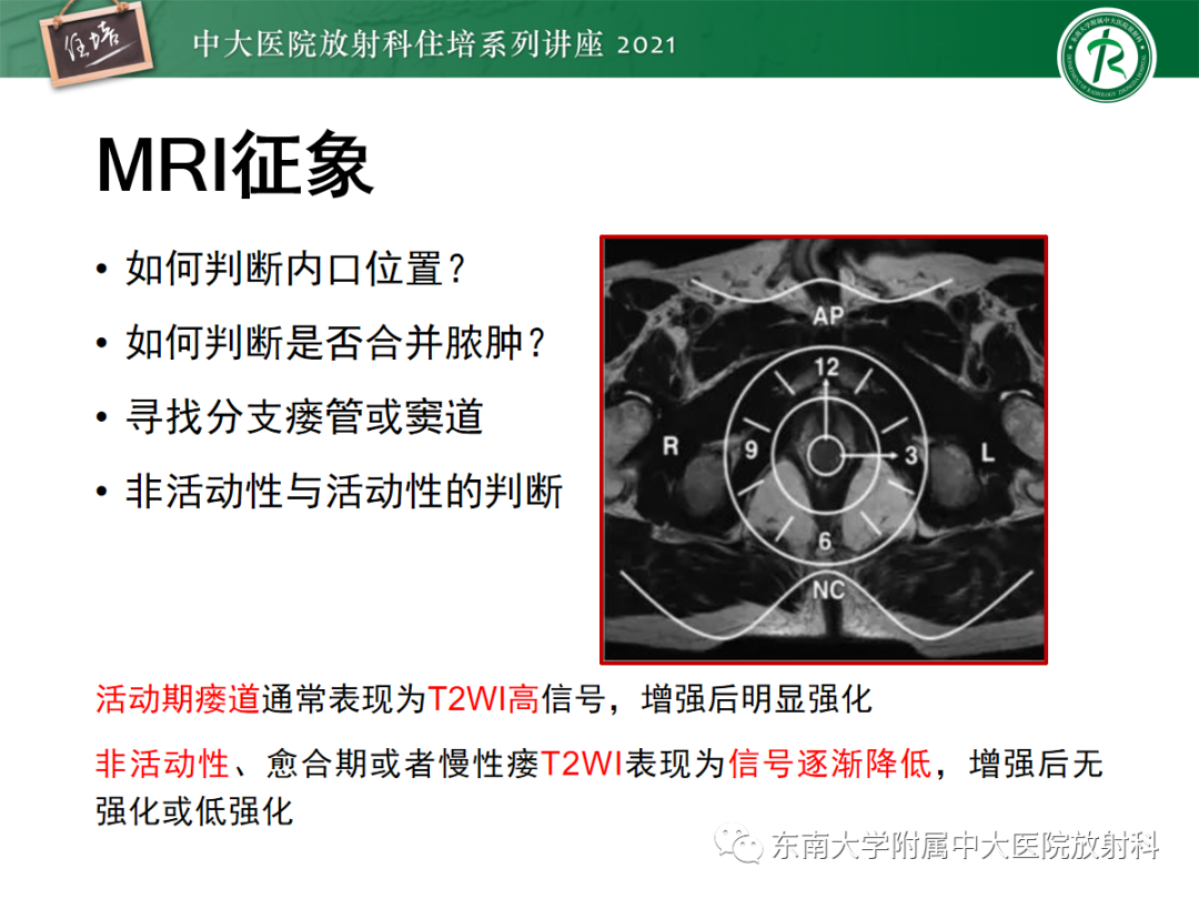 影像PPT - 【PPT】肛瘘的影像诊断及评估-17