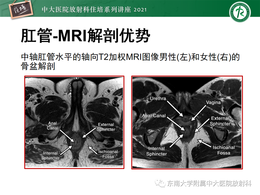 影像PPT - 【PPT】肛瘘的影像诊断及评估-14