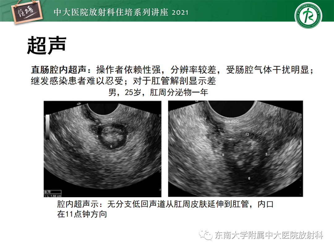 影像PPT - 【PPT】肛瘘的影像诊断及评估-10
