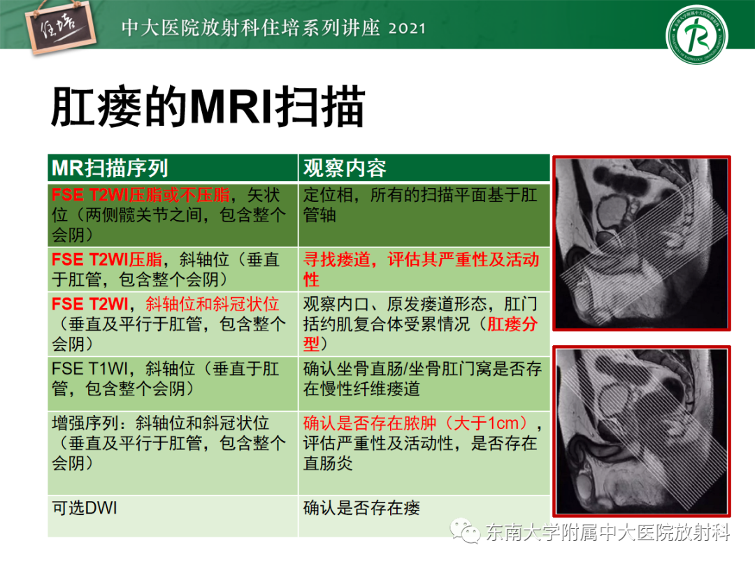影像PPT - 【PPT】肛瘘的影像诊断及评估-16