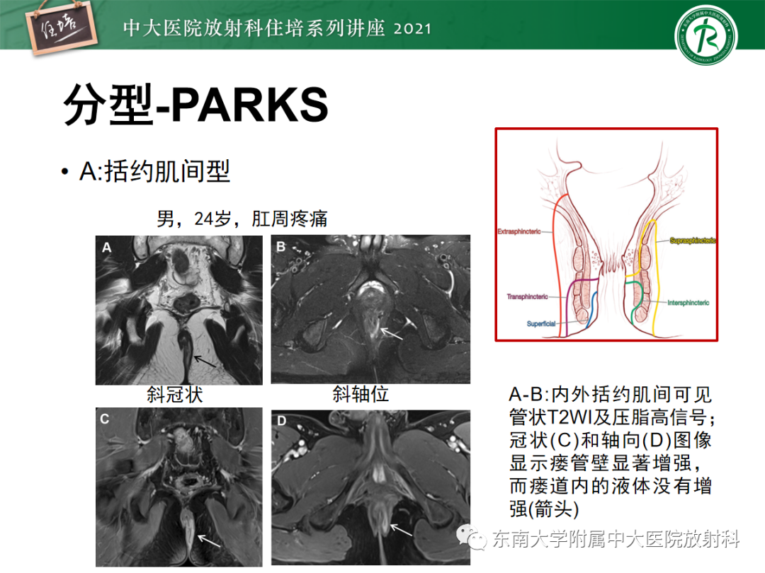 影像PPT - 【PPT】肛瘘的影像诊断及评估-21