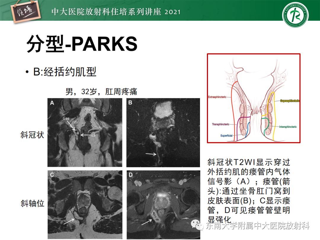 影像PPT - 【PPT】肛瘘的影像诊断及评估-22
