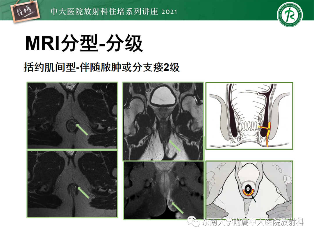 影像PPT - 【PPT】肛瘘的影像诊断及评估-29