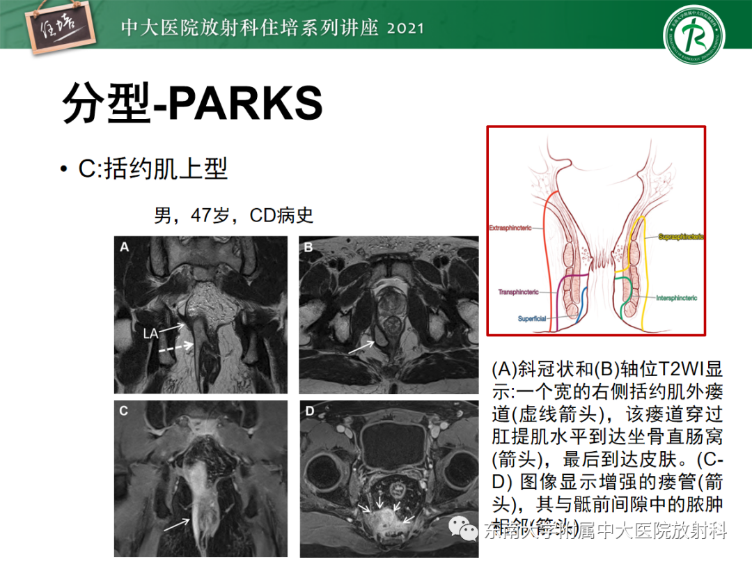影像PPT - 【PPT】肛瘘的影像诊断及评估-23