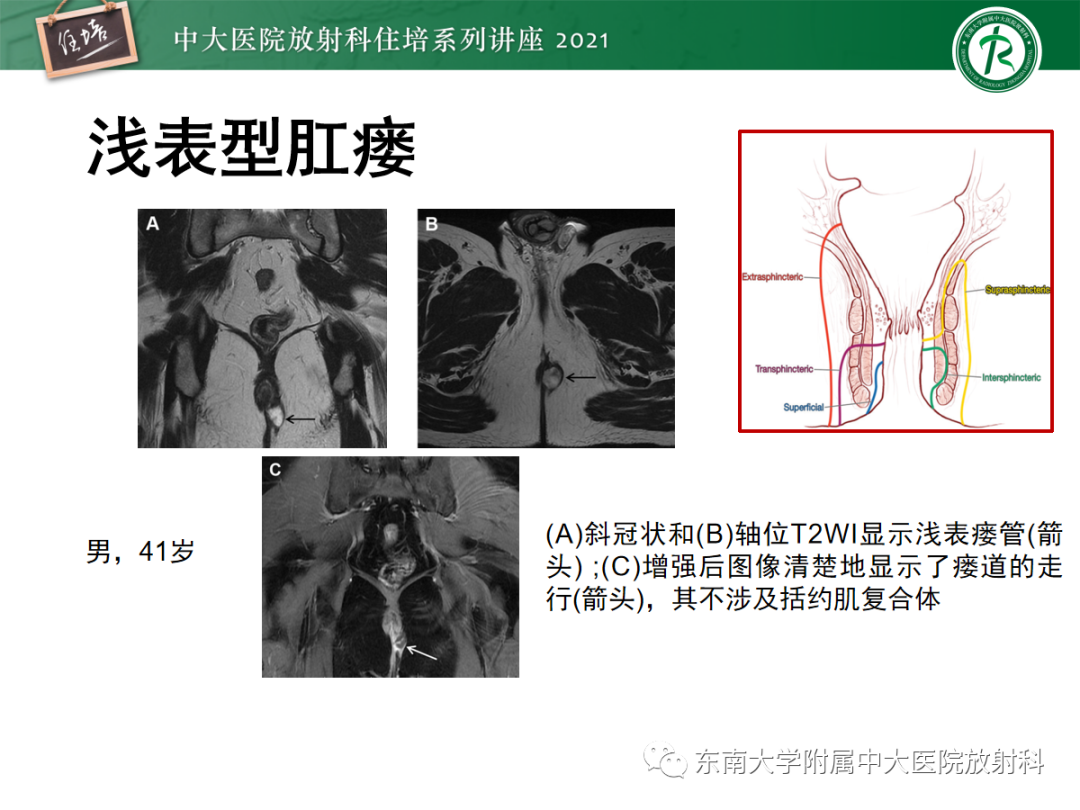影像PPT - 【PPT】肛瘘的影像诊断及评估-25